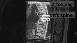 MRI Scan of Spine Showing Potts CervicalThoracicLumber Spine t2tsesag Sequence beginners [upl. by Suzan685]