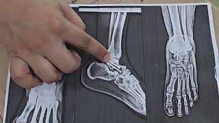 ankleinjury talus bone fracture calcaneus bone joint footfracture [upl. by Reprah978]