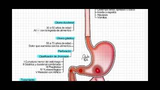 Úlcera péptida gástrica y duodenal [upl. by Hess]