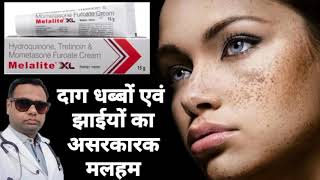 Melalite XL Ointment for melasma। Metacortil ointment review Hydroquinone Tretinoin amp Mometasone [upl. by Elrem]