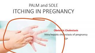 Obstetrics Cholestasis Pregnancy IntraHepatic Liver ICP Itching Palm pregnant Bile Acid Ursodiol [upl. by Levitus]