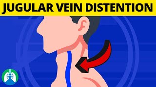 What is Jugular Venous Distention Medical Definition and Explanation [upl. by Ahsiela]