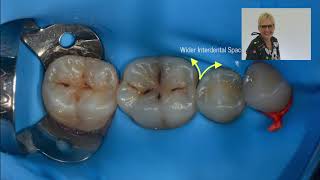 Matrixing  Young Permanent Molars [upl. by Sigismund792]