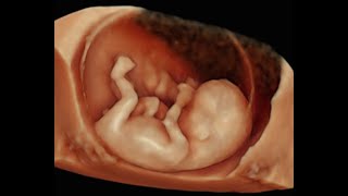 How to Perform 3D Scan of the Baby at 12 Weeks of Pregnancy [upl. by Belloir]