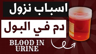 27اسباب نزول الدم في البول Hematuria amp Hemoglobinuria وتفسير العلاقة بين الدم والشريط والميكروسكوب [upl. by Navar]