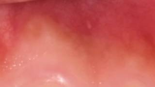 यह लक्षण दिखें तो तुरंत डॉक्टर के पास जाइए मुंह का कैंसर हो सकता है Mouth Cancer Ke Lakshan Symptoms [upl. by Merline]