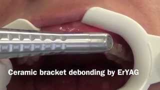 Ceramic bracket debonding by ErYAG [upl. by Clarabelle318]