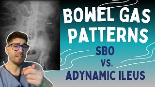 SBO vs Adynamic Ileus Learn the 369 rule to read bowel gas patterns on Xrays [upl. by Patin667]