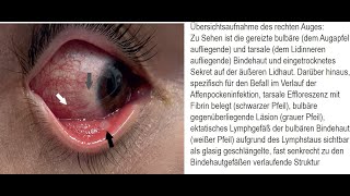 Beidseitige Bindehautentzündung Konjunktivitis im Verlauf einer Affenpockeninfektion [upl. by Hafeetal323]