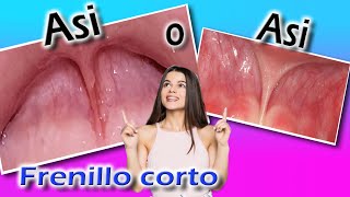 FRENILLO CORTO lingual y labial  DIENTES SEPARADOS  lengua ANQUILOSADA como afecta en los bebés [upl. by Dennet993]