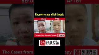 Real recovery case of ichthyosis of head and face parts ichthyosis skincare dermatologistdryskin [upl. by Channa]