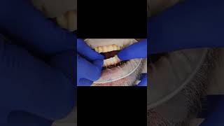 Full arch milled PMMA dental bridge for single piece dental implants shorts [upl. by Ahsropal964]