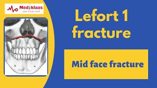 Le Fort I Fracture l Mid face fracture l Oral surgery l Mediklaas [upl. by Johst]