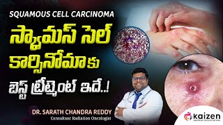 BEST treatment for squamous cell carcinoma  DrSarath Chandra Reddy  Kaizen Hematology Network [upl. by Aynor]