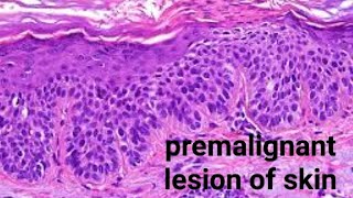 Premalignant skin lesions [upl. by Porta]