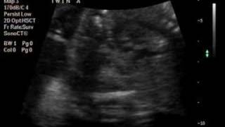 Baby Twin A ultrasound with heartbeat [upl. by Rochemont566]