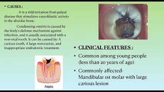 condensing osteitis [upl. by Irene506]