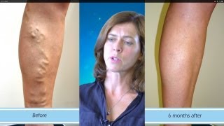 Amazing Results from Varicose Vein Surgery [upl. by Deanna]