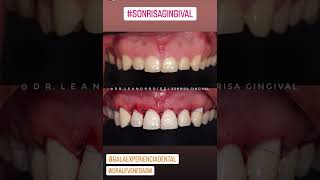 Sonrisa gingival alargamiento de corona gingivectomia osteoplastia [upl. by Nani145]