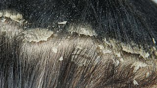 Dandruff Scratching Big Flakes Satisfying  Dandruff Removal 1268 [upl. by Nonnarb695]