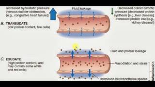 PATHOLOGY LECTURES  Hemodynamic Disorder  EXUDATES and TRANSUDATES [upl. by Ahseetal]