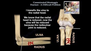 Comminuted Monteggia Fracture Difficult Problem  Everything You Need To Know  Dr Nabil Ebraheim [upl. by Janyte]