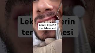 Diş lekelerinin temizlenmesi dentist dentistry [upl. by Amabelle]