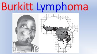 Burkitt lymphoma overview [upl. by Derrek384]