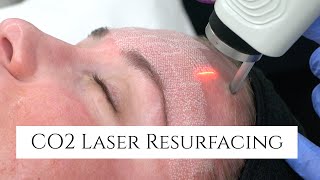 CO2 Laser Facial Rejuvenation  Fix Fine Lines and Wrinkles  Fix Sun Damage  Fix Stretch Marks [upl. by Enyledam]