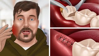 ASMR Animation Wisdom teeth treatment for MrBeast  WOW Brain Dental care [upl. by Frulla667]