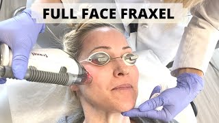 FRAXEL LASER TREATMENT WITH DR STEFANI KAPPEL  FULL FACE BEFORE amp AFTER  EP031 [upl. by Epifano]