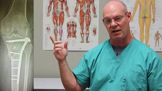 Knee Arthritis amp Tibial Plateau Fracture  Fracture Friday Episode 13 [upl. by Berner]