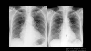 Thorax  Semiologia Radiológica do Tórax  PARTE 1 [upl. by Arahas]