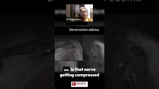 Denervation Edema  Dr Malini Lawande [upl. by Jerrold]