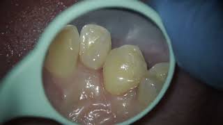 treatment of caries and composite filling on the tooth dentist teeth dental cavity dentistry [upl. by Aynwat]