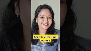 Acne to clear skin Journey 🔥acne acneproneskin skincare skincareroutine clearskin [upl. by Flower]