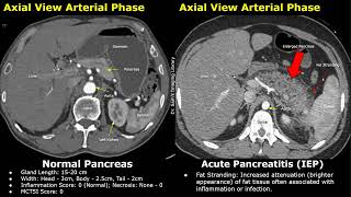 CT Normal Pancreas Vs Acute Pancreatitis  Balthazar Modified CT Severity Index MCTSI Scoring [upl. by Redliw223]