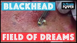 Blackhead Field of Dreams Supercomedones amp Dilated Pores of Winer [upl. by Ahsikahs680]