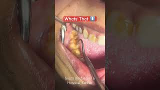 Vertical root fracture katihar katiharbihar trending viralshorts dentist dentalcare [upl. by Lledyl141]