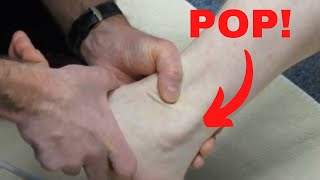 Peroneus longus subluxation How to treat it [upl. by Legnalos951]