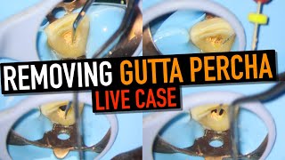 GUTTA PERCHA REMOVAL  RERCT FULL CASE  4K Resolution [upl. by Remlap]