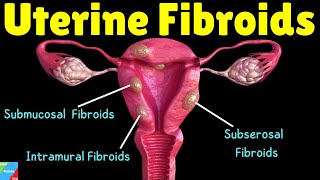 Uterine Fibroids Types Symptoms Causes Diagnosis Treatment and Complications [upl. by Sgninnej]