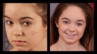 Acne Coverage Foundation Routine [upl. by Anala]