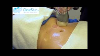 VelaShape Treatment for Cellulite at ClearSkin [upl. by Nera]