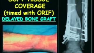 Salvaging Severe Pilon Fractures [upl. by Calvin]