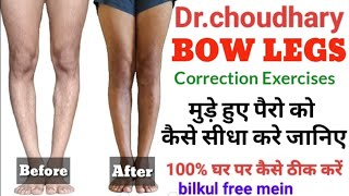 Bow Legs Correction Exercises in hindi  Bow leg correction at home  How to fix bowed legsphysioth [upl. by Stacia]