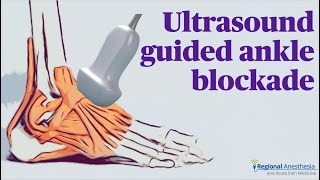 Ultrasound Guided Ankle Block [upl. by Einal]