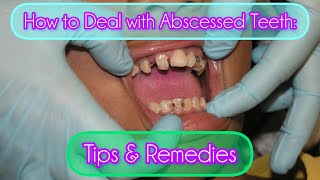 How to Deal with Abscessed Teeth Tips amp Remedies [upl. by Yand]