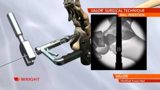 VALOR™ Hindfoot Fusion Nail System Animation [upl. by Ziagos]