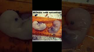 20 weeks twins miscarriage 🤰🥺knowledge easylearning medicalstudents shortsvideo share [upl. by Ymled901]